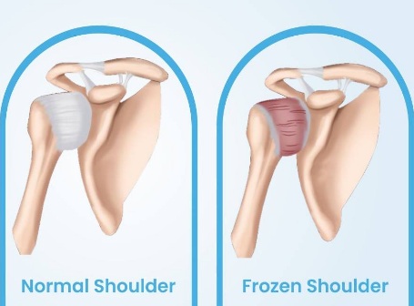 How to cure Frozen Shoulder pain in Work Life?